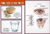 21 Natural Home Remedies For Pink Eye Relief