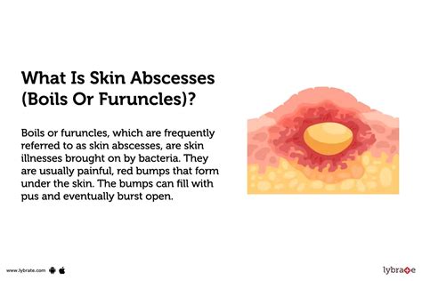 Skin Abscesses Boils Or Furuncles Causes Symptoms Treatment And Cost