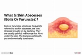 Skin Abscesses (Boils Or Furuncles): Causes, Symptoms, Treatment And Cost