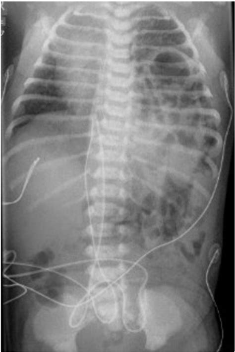 Figure 1 From Contralateral Chylothorax After Congenital Diaphragmatic