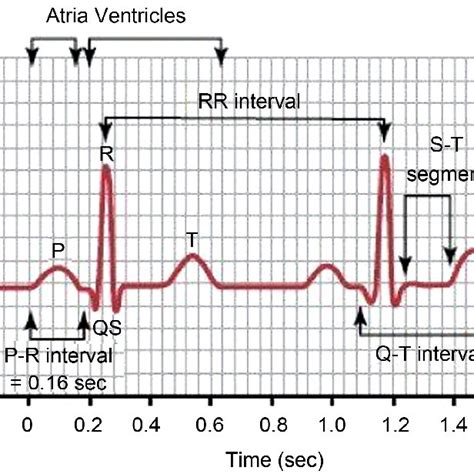 Electrocardiographic Tracing After Administering Adenosine The Full