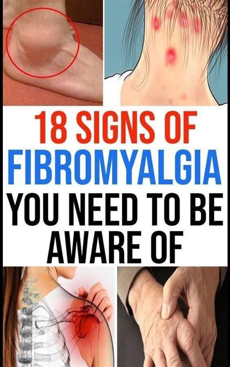 43 Signs Of Fibromyalgia You Should Be Aware Of Harveycliniccare