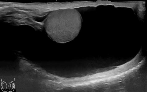 Hidrocele En Testículo Causas Tipos Y Tratamientos