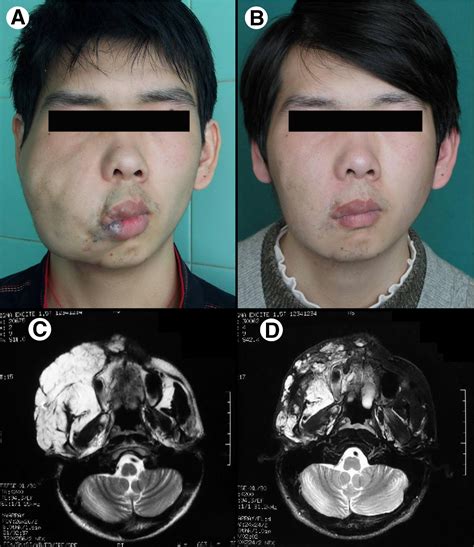 Craniofacial Venous Malformations Magnetic Resonance Imaging Features