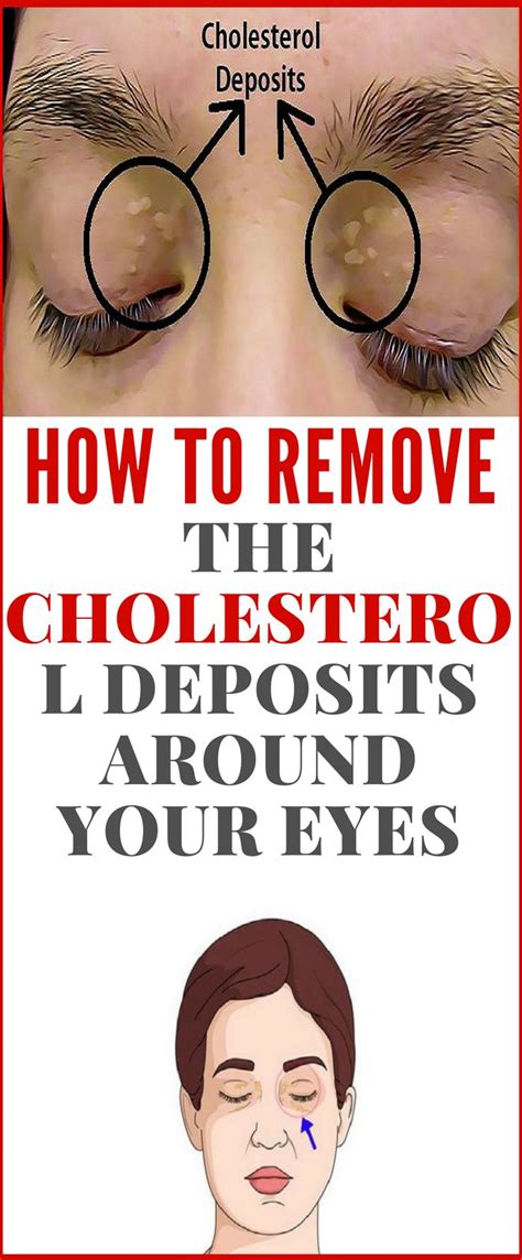 How To Remove The Cholesterol Deposits Around Your Eyes How To Remove