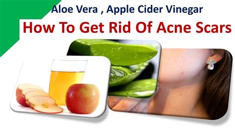 How To Get Rid Of Acne Scars Aloe Vera Apple Cider Vinegar Youtube