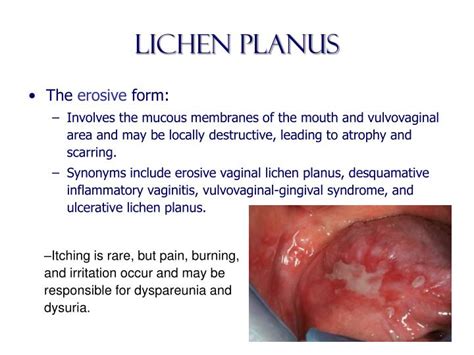 lichen planus genital images images and photos finder