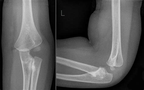 Bilateral Congenital Radial Head Dislocation Radiology Case