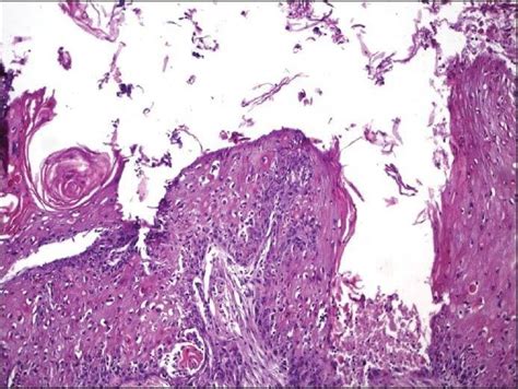 Histopathology Of Squamous Cell Carcinoma In Dermoid Cyst Download