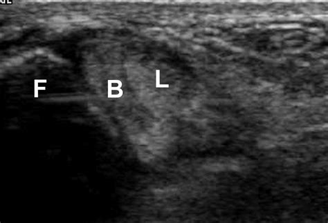 Dynamic Sonographic Evaluation Of Peroneal Tendon Subluxation Ajr