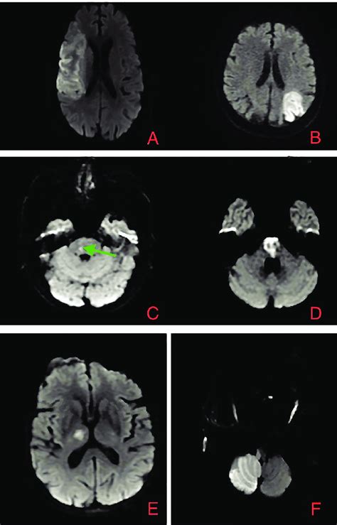 Magnetic Resonance Imaging Mri Of Acute Ischemic Strokes In Right