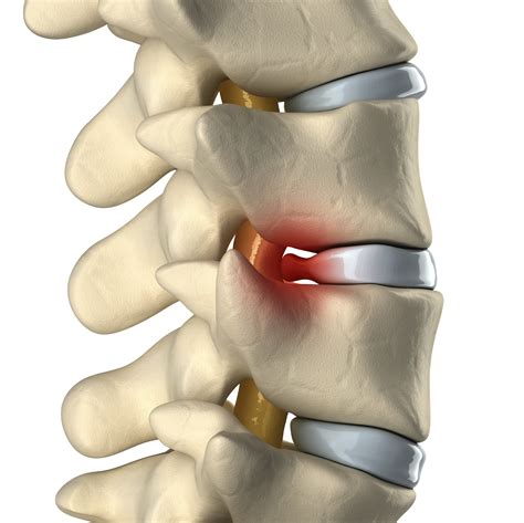 Herniated Disc Bulging Disc Protruding Disc Michigan Spine Pain