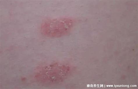 玫瑰糠疹图片初期症状，和梅毒皮疹难区分治疗时不能烫水洗澡 — 神奇养生网