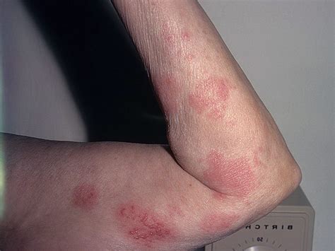 Medical Shingles Pictures 54 Photos And Images