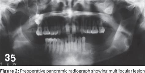 Figure 1 From The Syndromic Multiple Odontogenic Keratocyst In Siblings