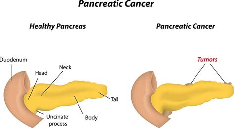Pancreatic Cancer 10 Silent Signs And Symptoms Healthella