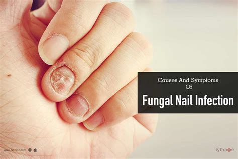 Causes And Symptoms Of Fungal Nail Infection