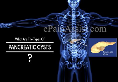 What Are The Types Of Pancreatic Cysts And How Do You Remove A Pancreatic