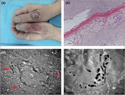 Image Gallery Recurrent Bovine Papular Stomatitis Virus Infection