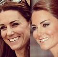 Kate botox preenchimento | Botox fillers, Botox forehead, Botox brow lift