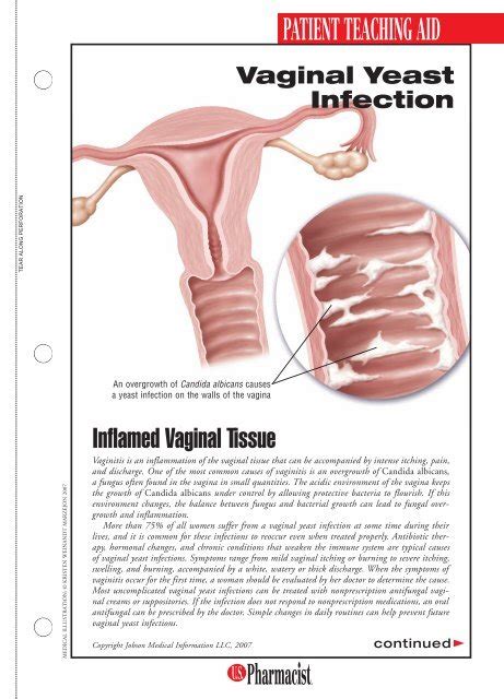 Vaginal Yeast Infection Us Pharmacist