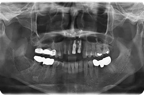 Subapical osteotomy to correct dental implant ...