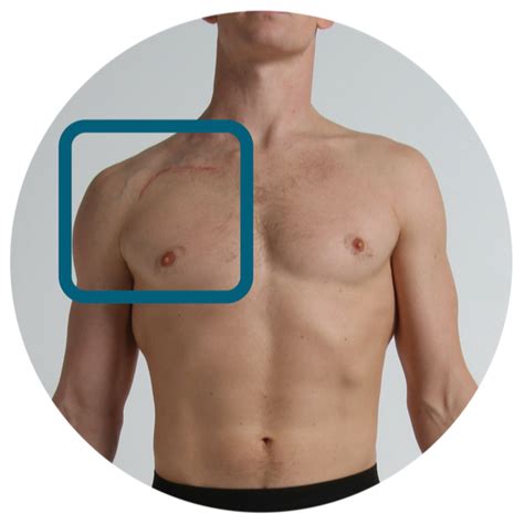 Shoulder tendonitis is the inflammation, irritation and swelling of the tendons in the rotator cuff and there are two areas of the shoulder where tendonitis may develop. Shoulder Tendons Chart - Shoulder Range Of Motion Chart ...