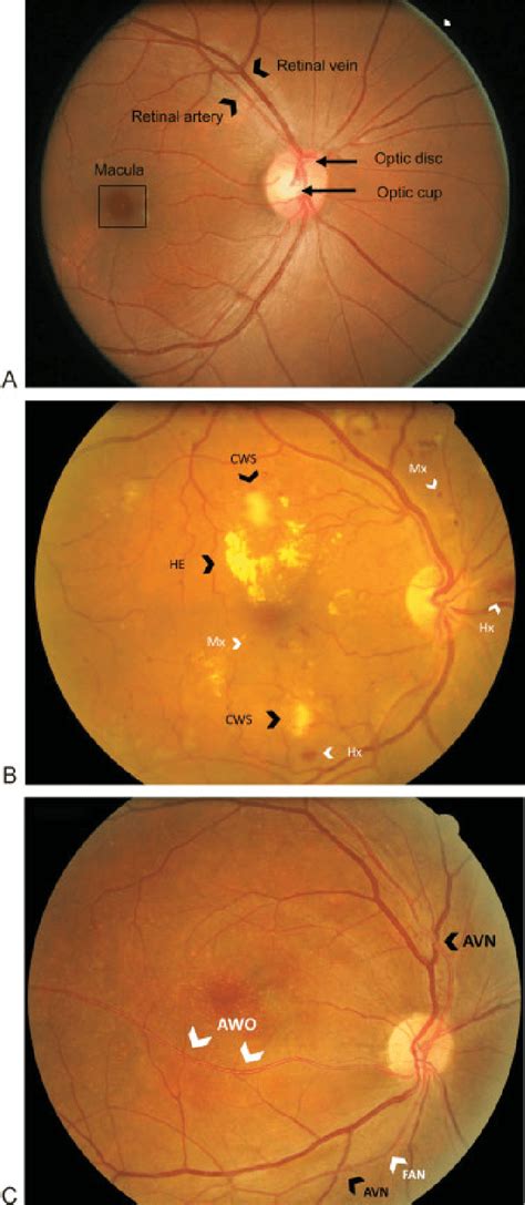 Hypertensive Retinopathy Vs Diabetic Retinopathy