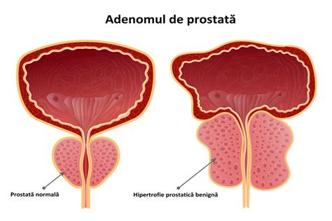 Adenom De Prostata Cauze Simptome Complicatii Tratament Bioclinica