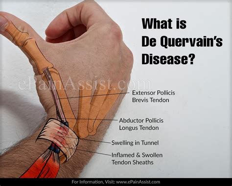 It occurs when the 2 tendons around the base of your thumb become swollen. What is De Quervain's Disease? | Inflammatory arthritis ...
