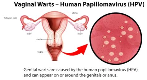 Vaginal Wart