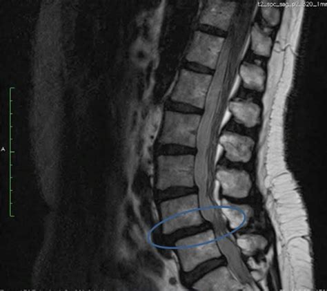 Severe Lumbar Spinal Stenosis With Spondylolisthesis