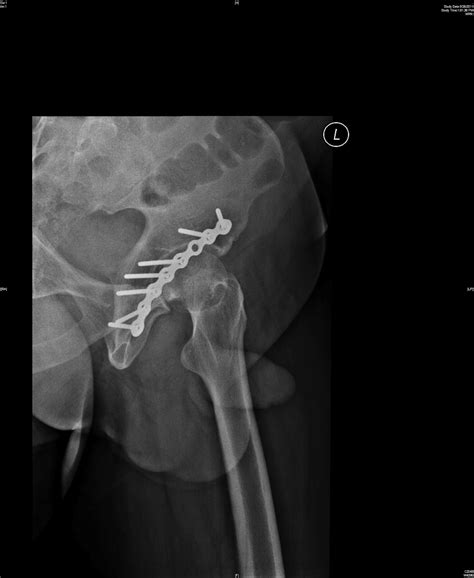 Types Of Hip Fractures Fracture Treatment