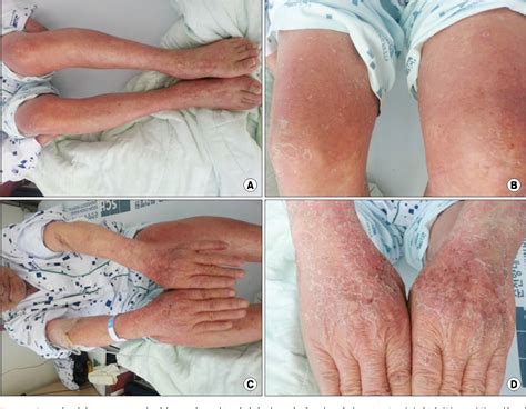 Pdf A Case Of The Drug Reaction With Eosinophilia And Systemic