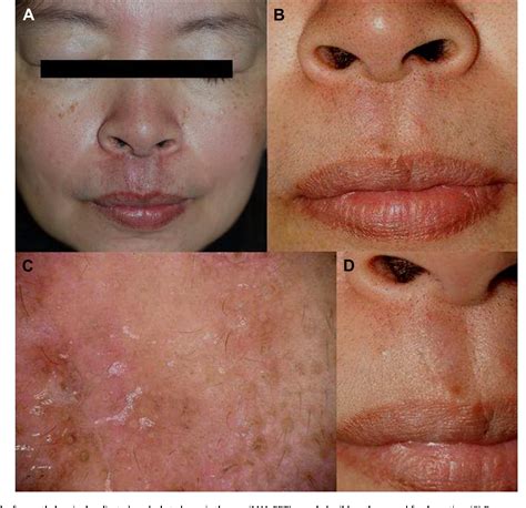 Figure 2 From Successful Treatment Of Superficial Basal Cell Carcinoma