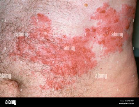 Herpes Zoster Or Shingles On The Stomach Region Of A Man They Show