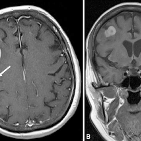 Preoperative Mri Revealed A Solid Tumor In The Right Frontal Lobe T1