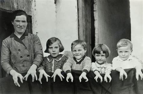 Cleft Hands Real People From American Horror Story Freak Show