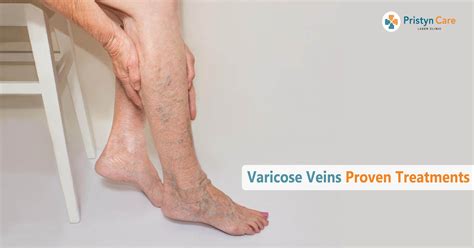 Varicose Veins Laser Treatment In Chandigarh 100 Painless Varicose