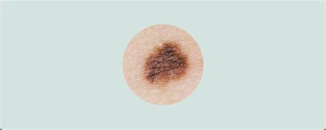 Types Of Moles What Spots To Look Out For On Your Skin Molemap Australia
