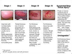 Figure B Depicts The Npuap Pressure Ulcer Stages I Iv With Descriptions Of The Stages And An