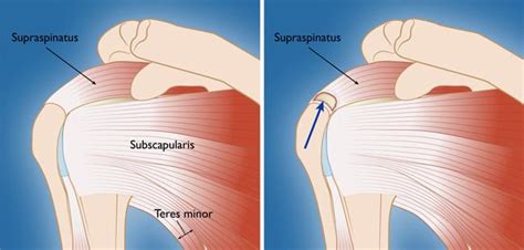 Rotator Cuff Tendonitis And Repair Orthopaedic Center Of Southern