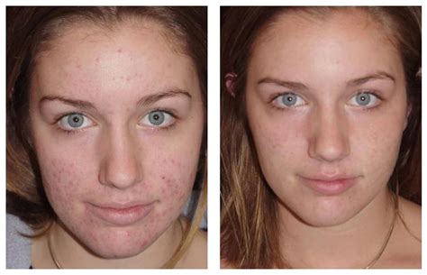 Laser Treatment For Acne And Acne Scarring Complexions Med Spa