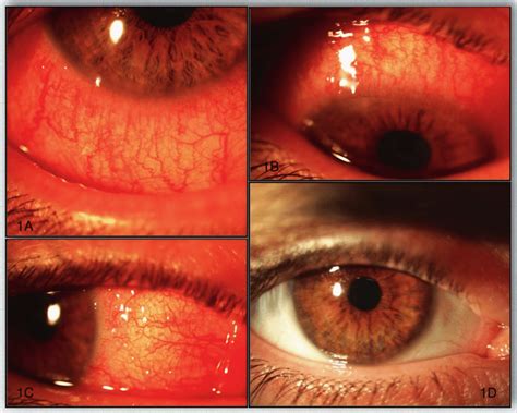 Acute Presentation Of Dupilumab Associated Conjunctivitis And Its
