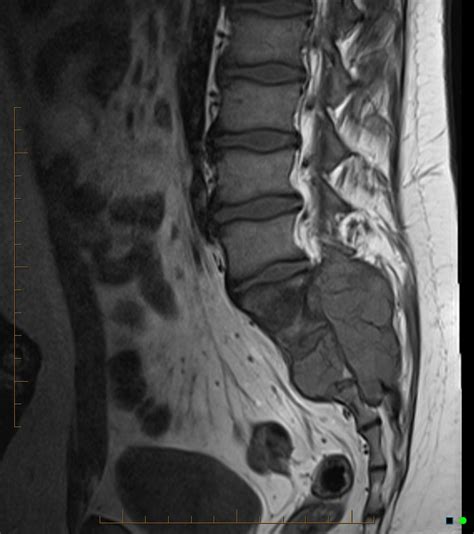 Aneurysmal Bone Cyst Sacrum Image