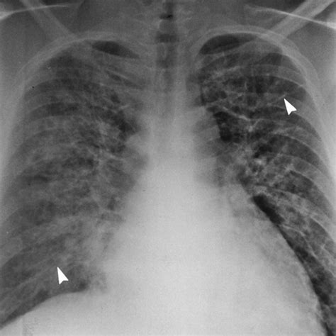 Clinical And Radiologic Features Of Pulmonary Edema Radiographics