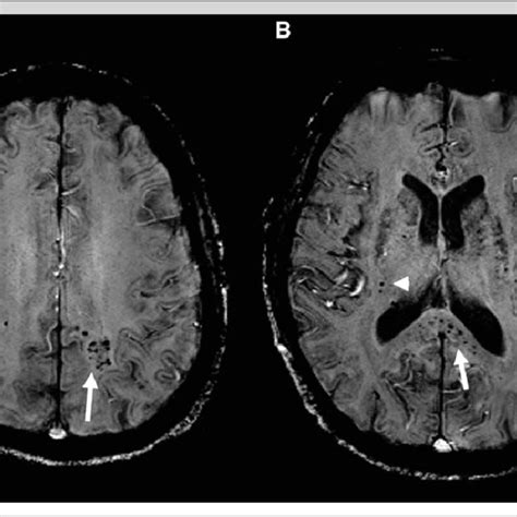 Cerebral Microbleeds In A Lobar Distribution As Well As Involvement Of
