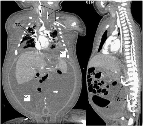 Congenital Extensive Central Venous Thrombosis With Chylous Ascites And