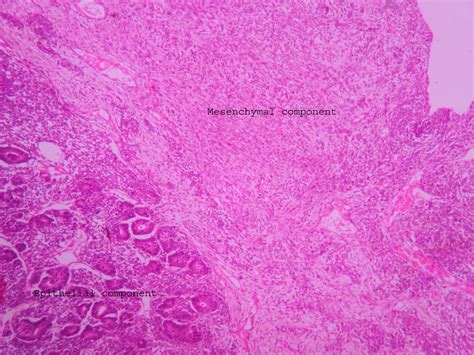 Wilms Tumor Ug Slide Histopathologyguru