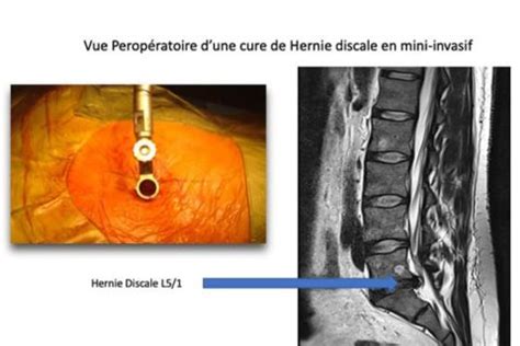 La Cure De Hernie Discale Mini Invasive Institut Du Rachis Paris